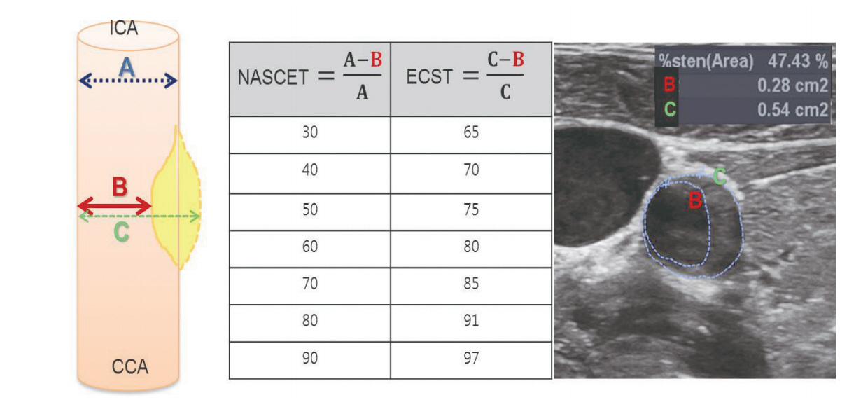 Процент стеноза сосудов. Стеноз сонных артерий на УЗИ. Степени стеноза сосудов. Степени стеноза брахиоцефальных артерий классификация. Измерение степени стеноза по nascet.
